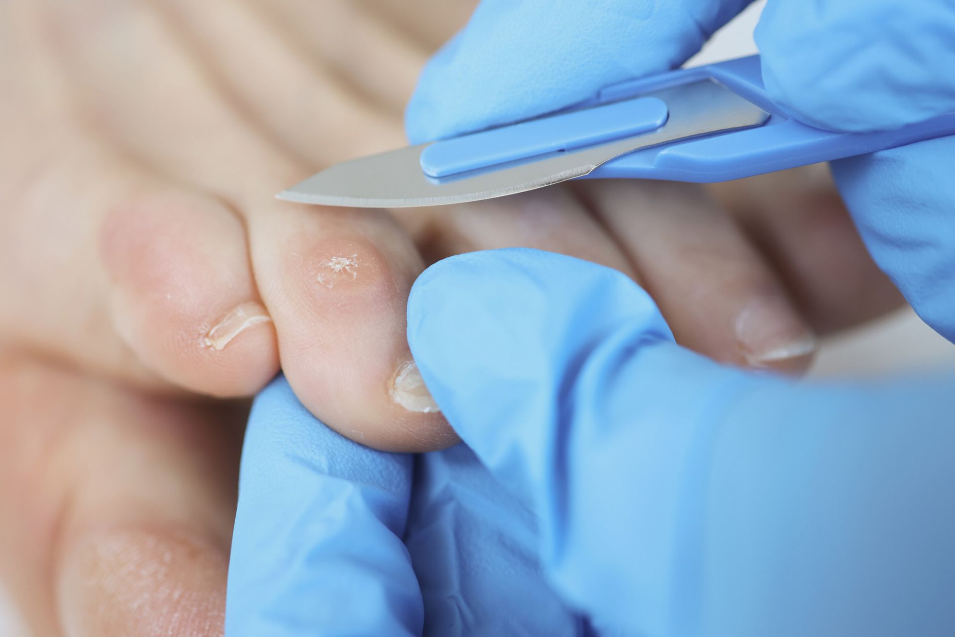 Corn and callus treatment
