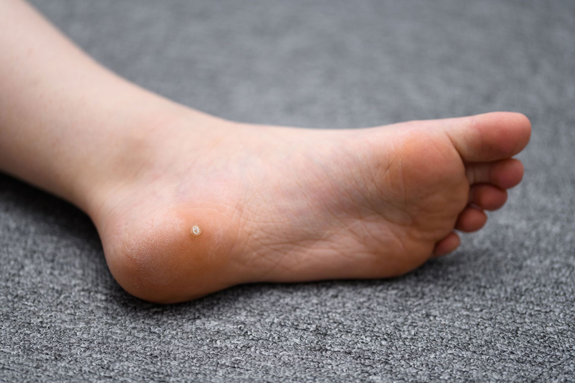 Ingrown toenail treatment